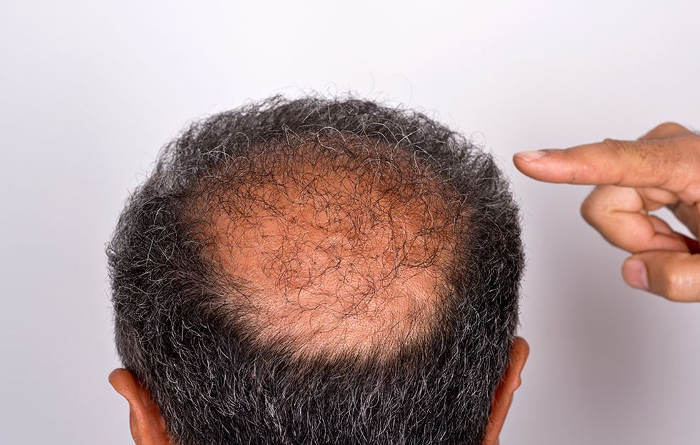 hair-loss-transplant-0-1494002030