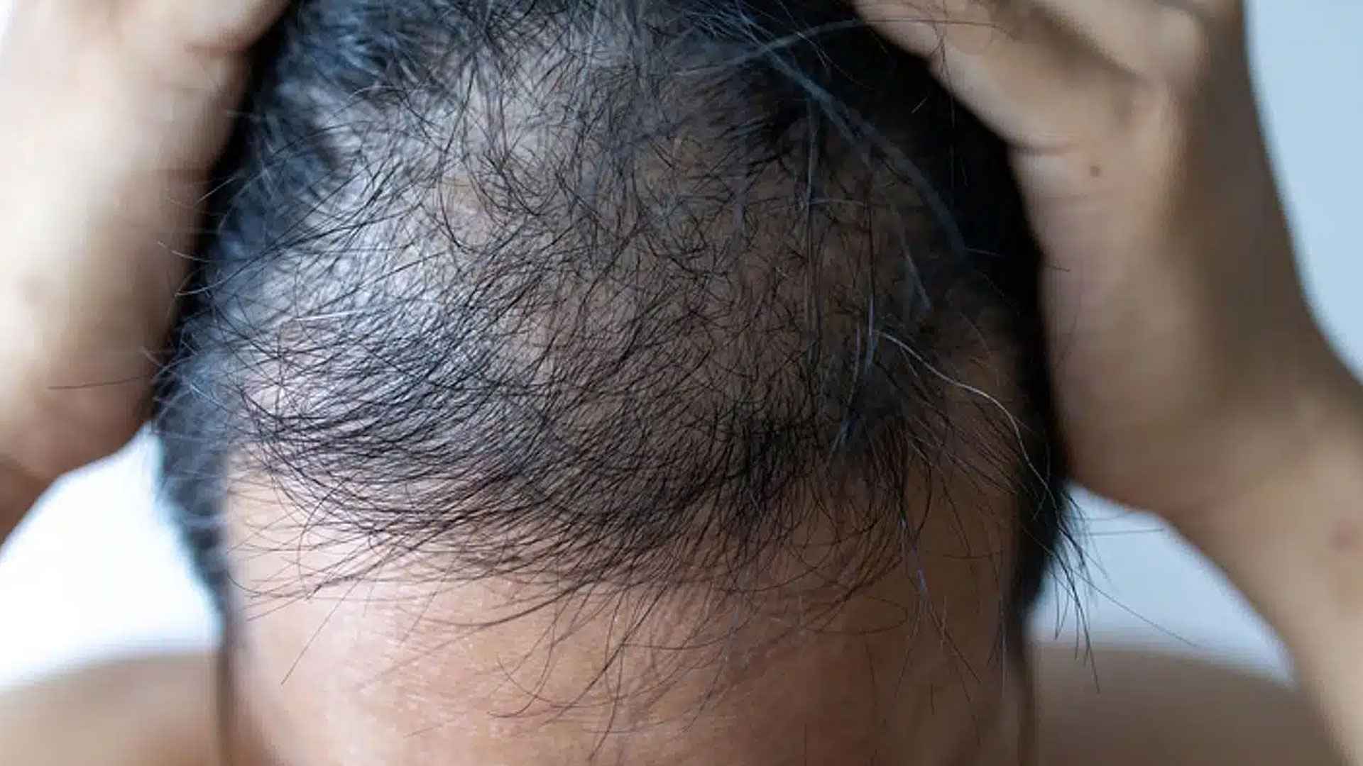 তরুণ বয়সেও মাথায় টাক পড়ছে কেন, মুক্তির উপায়ই বা কী?