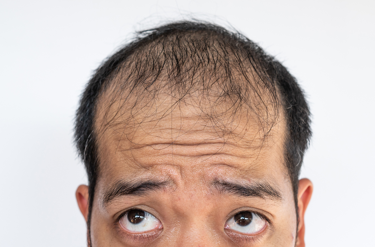 imgi_21_finasteride-for-hair-loss