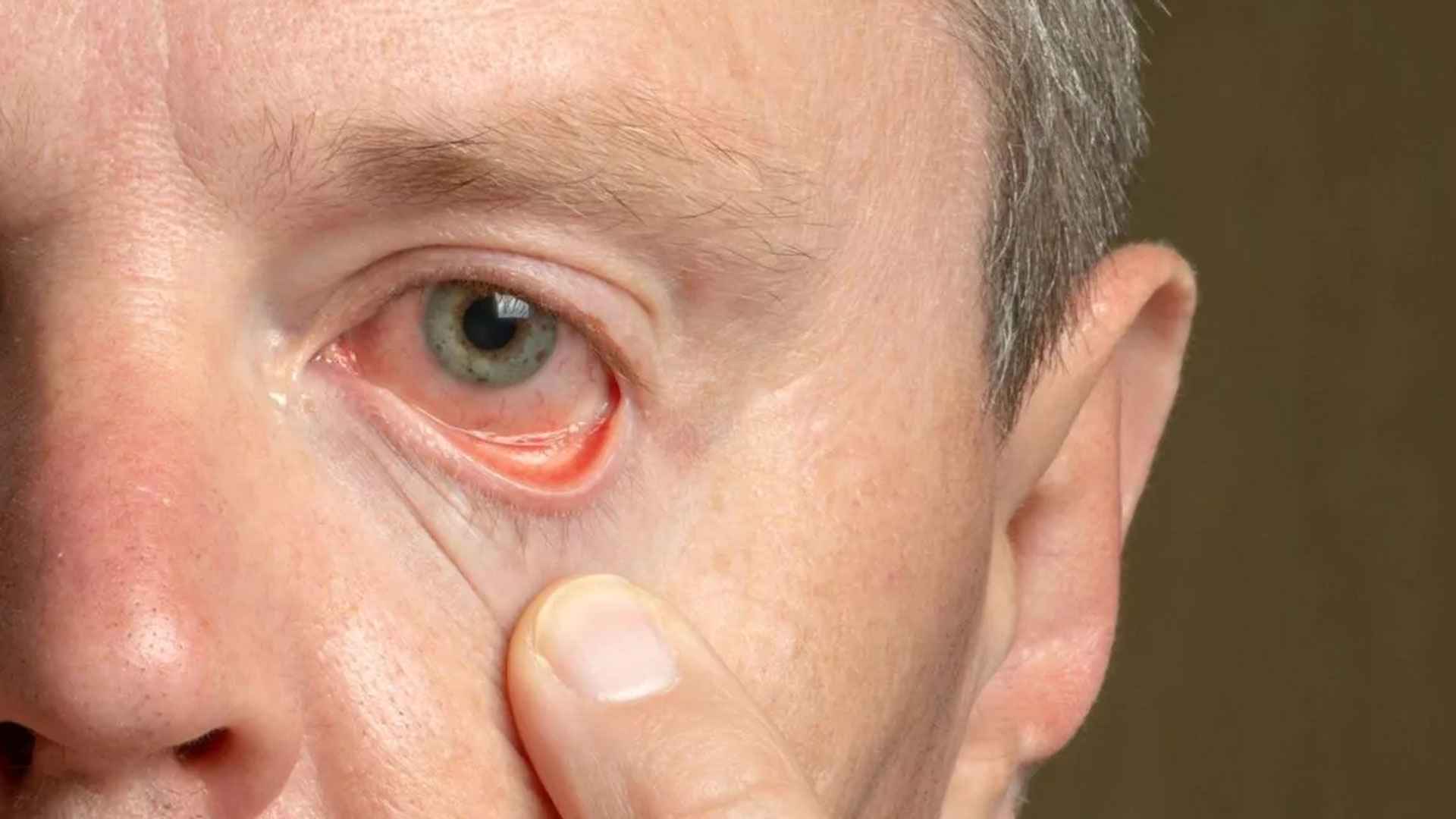 ত্বকের ৫ লক্ষণ দেখা দিলেই বুঝবেন কোলেস্টেরল বেড়েছে