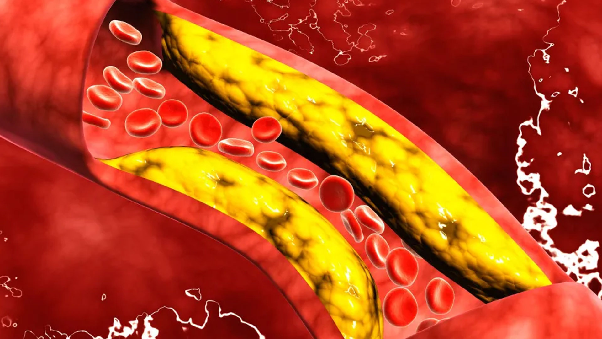 cholesterol2 cholesterol2
