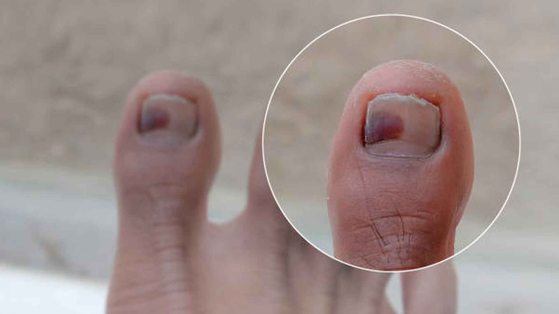 হঠাৎ আঘাত লেগে নখ উল্টে গেলে কী করবেন?