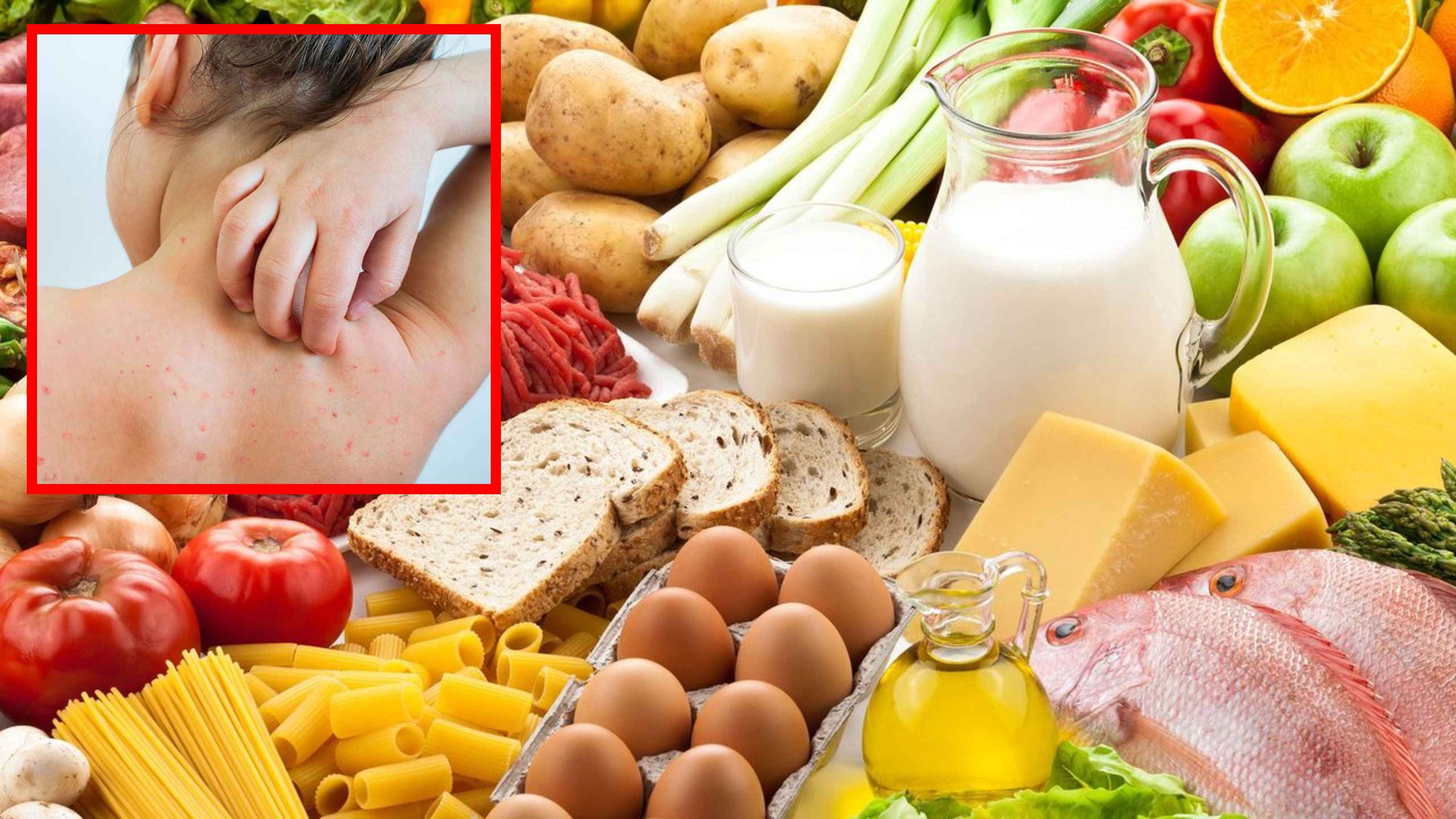 চিকেন পক্স হলে কী খাবেন?