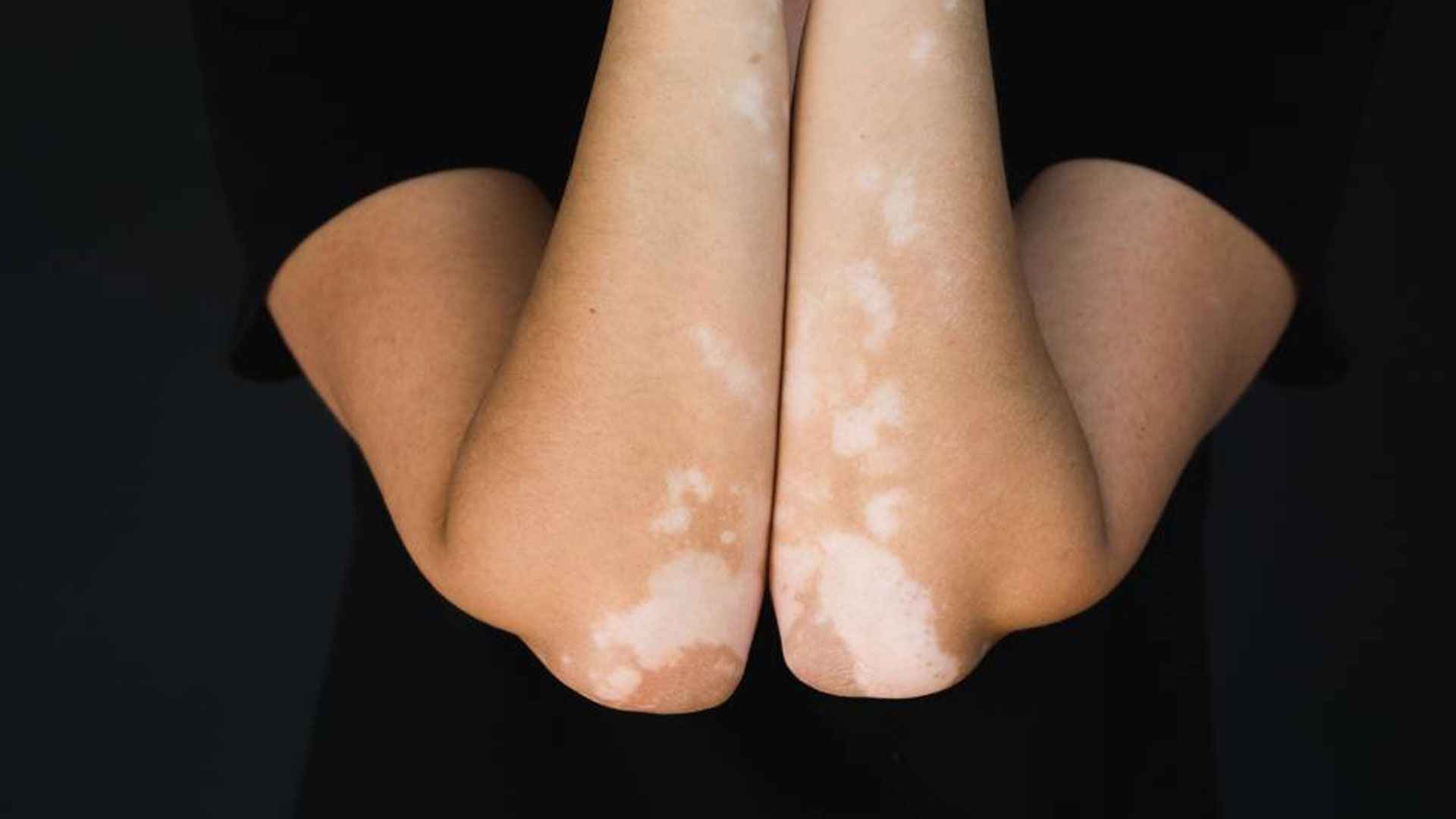 শ্বেতী রোগ কি ছোঁয়াচে, কেন হয়?