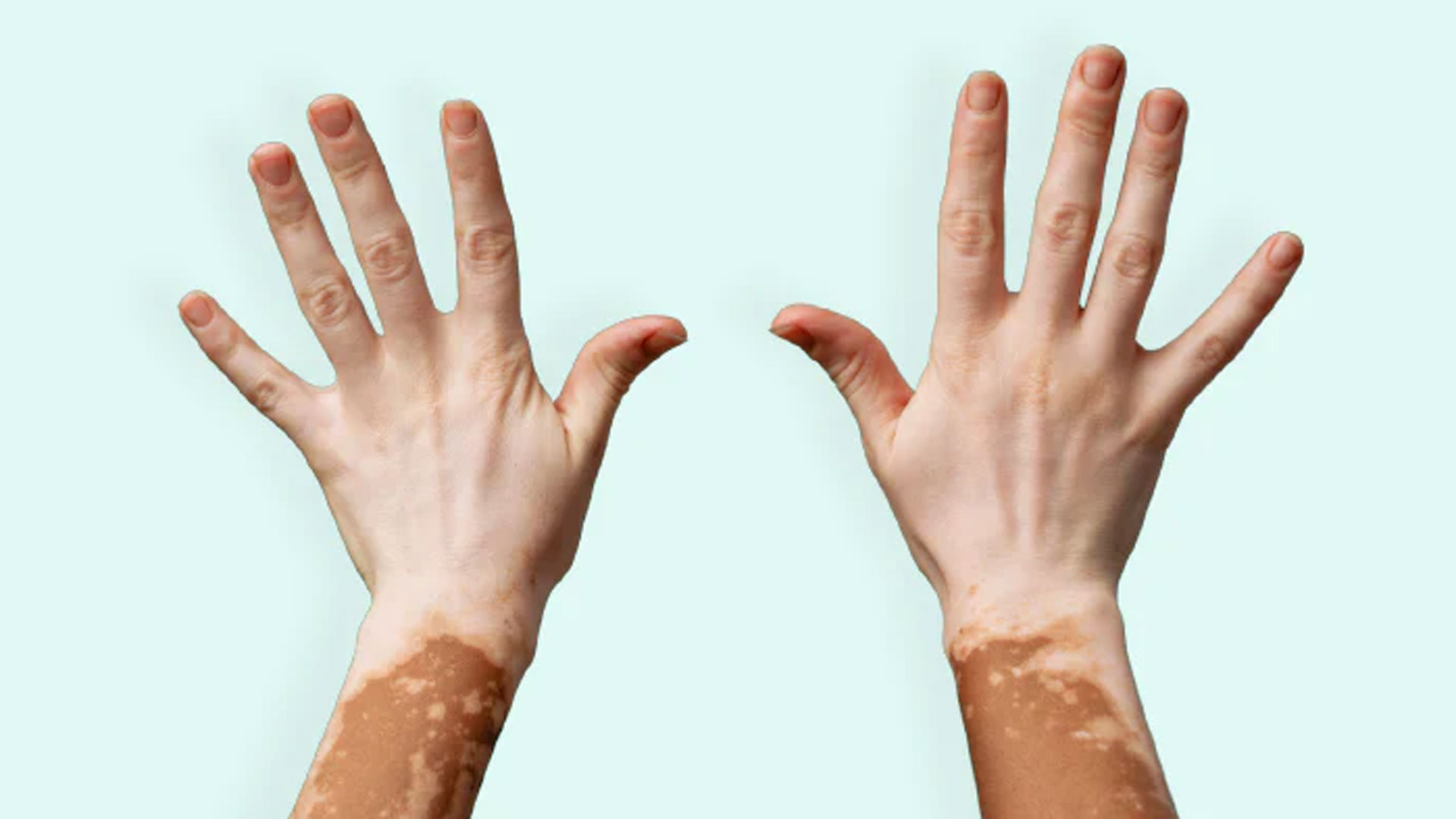 vitiligo2 vitiligo2