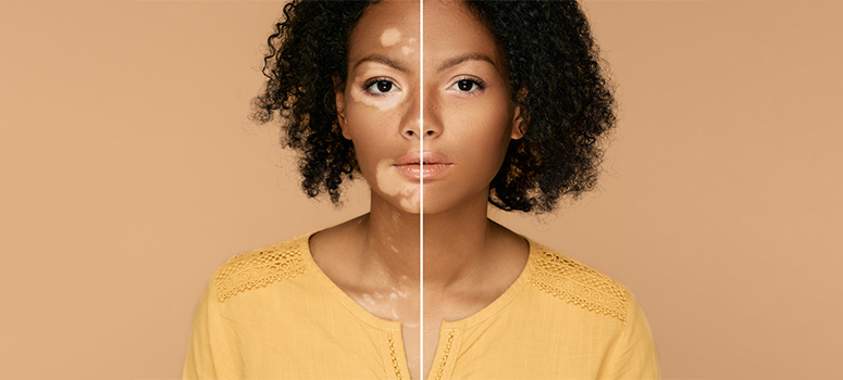 vitiligo4 vitiligo4
