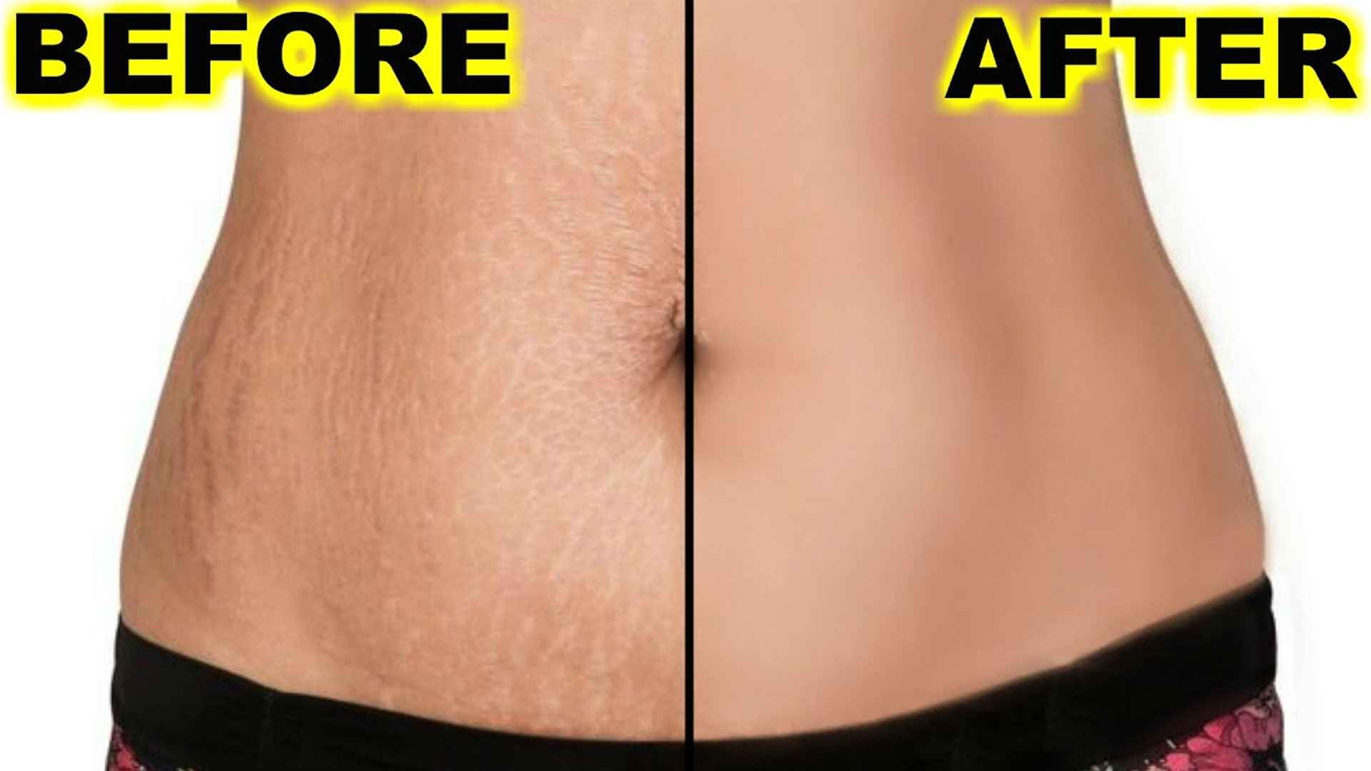 স্ট্রেস মার্কস দূর করার ঘরোয়া উপায়