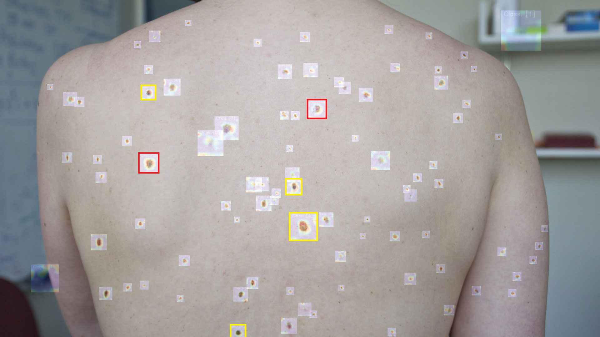 এআই কি আগে থেকে ত্বকের ক্যানসার চিহ্নিত করতে পারবে?