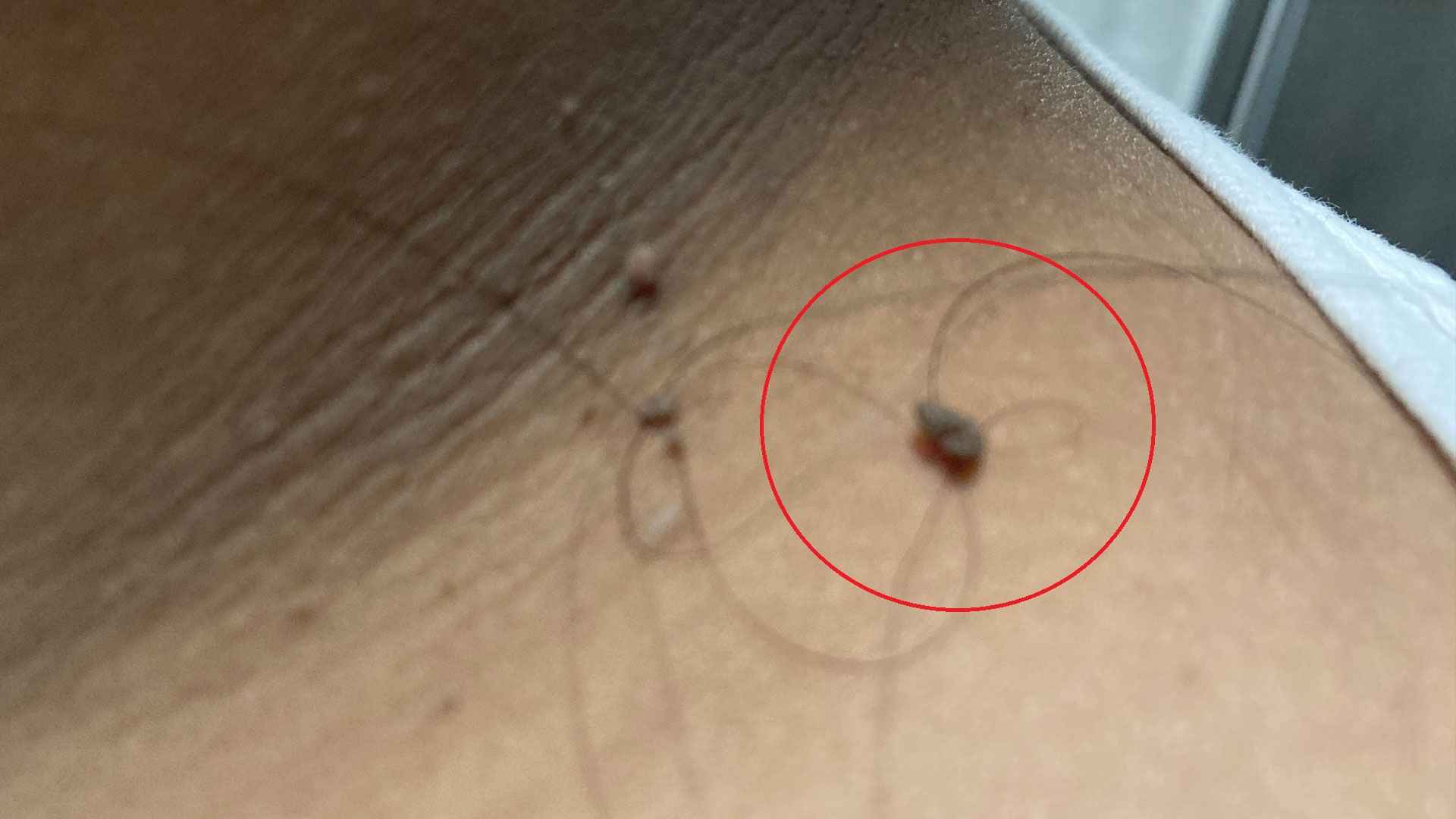 আঁচিলে চুল পেঁচিয়ে রাখা কি ভালো, নাকি বাড়ছে বিপদ?