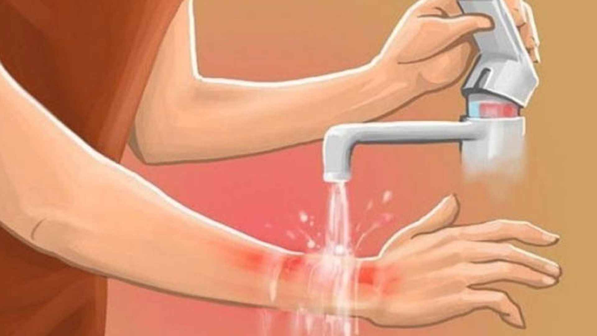 আগুনে পোড়া রোগীর প্রাথমিক চিকিৎসা