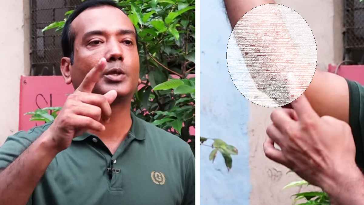 যাত্রাবাড়ীতে স্নাইপার দিয়ে গুলি, আঘাতের চিহ্ন দেখালেন ছাত্রদল সভাপতি