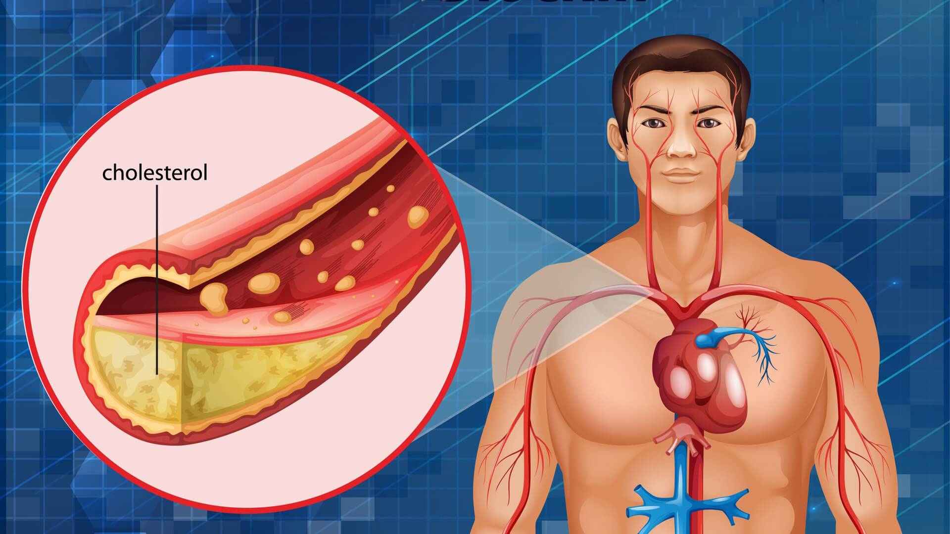 হঠাৎ শরীরের কোলেস্টেরলের মাত্রা বাড়ে কেন?