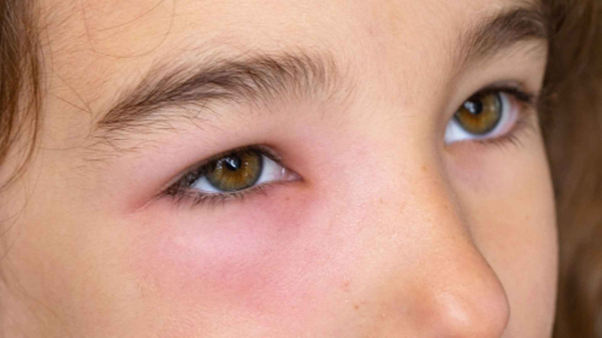 চোখের নিচে ফোলাভাবও হতে পারে কিডনি রোগের লক্ষণ