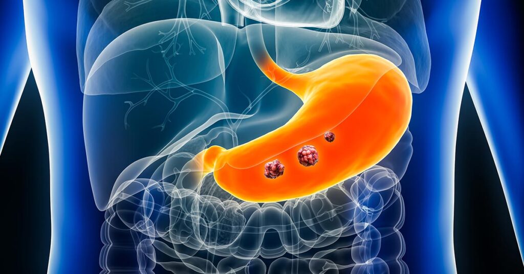 stomach_cancer1 stomach_cancer1