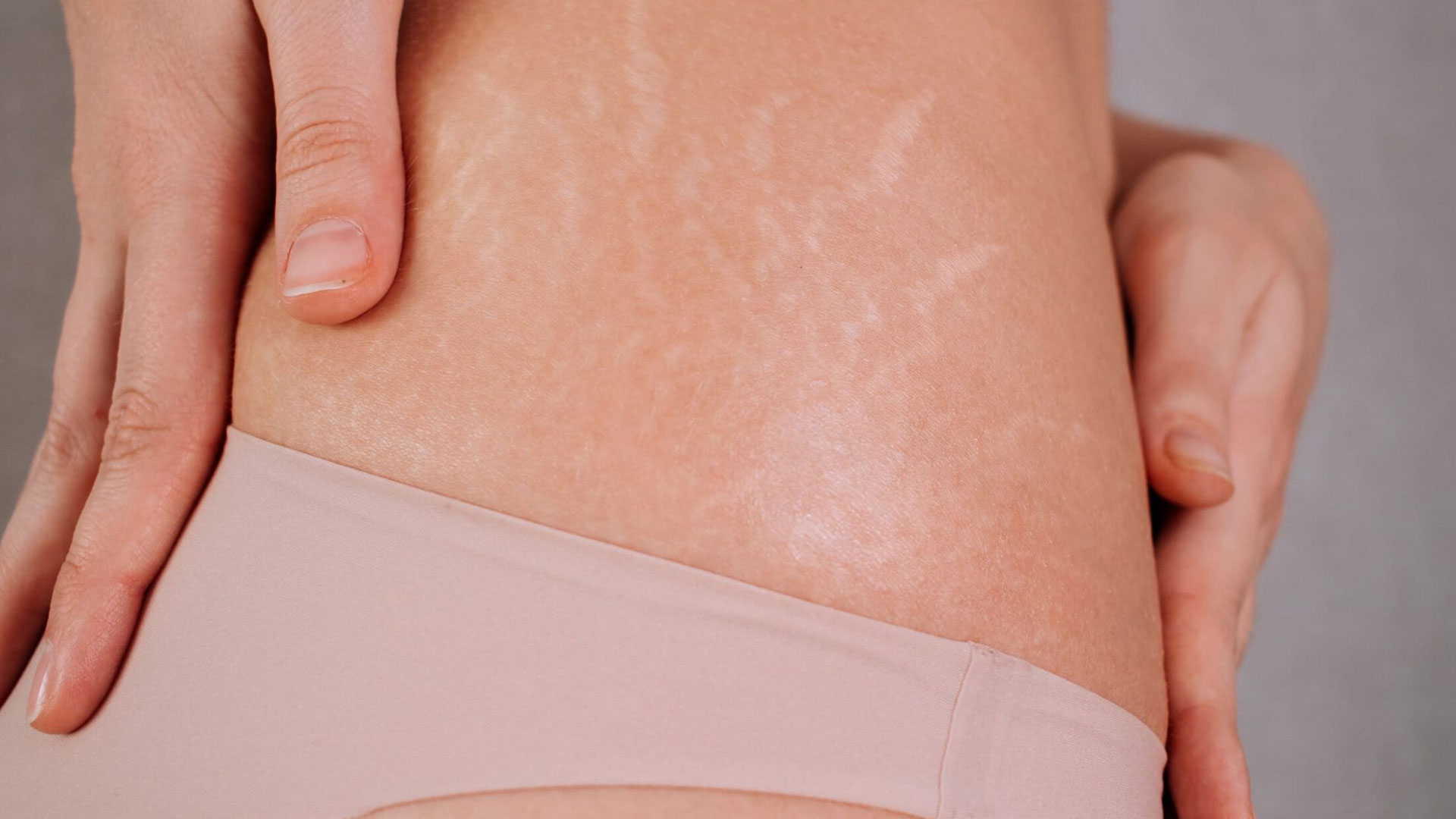 stretch-marks3 stretch-marks3