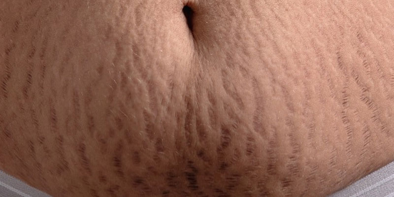 stretch-marks stretch-marks