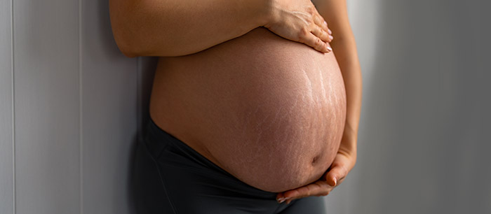 stretch_marks2 stretch_marks2