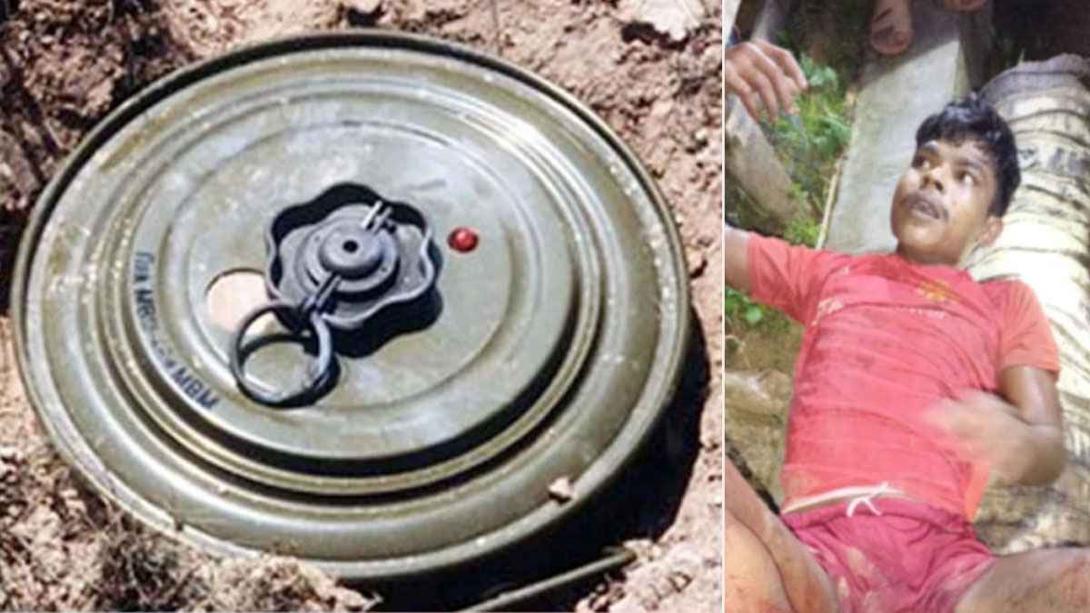 মিয়ানমারে মাইন বিস্ফোরণে রোহিঙ্গা যুবকের পা বিচ্ছিন্ন