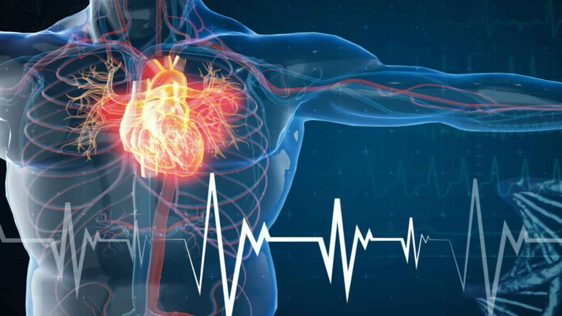 heart attack