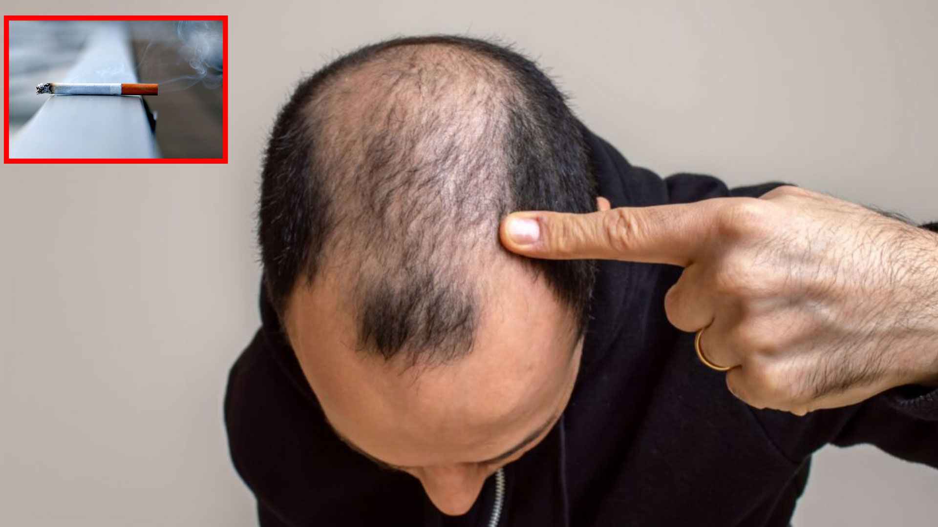 ধূমপান কি চুল পড়ার সমস্যা বাড়ায়?