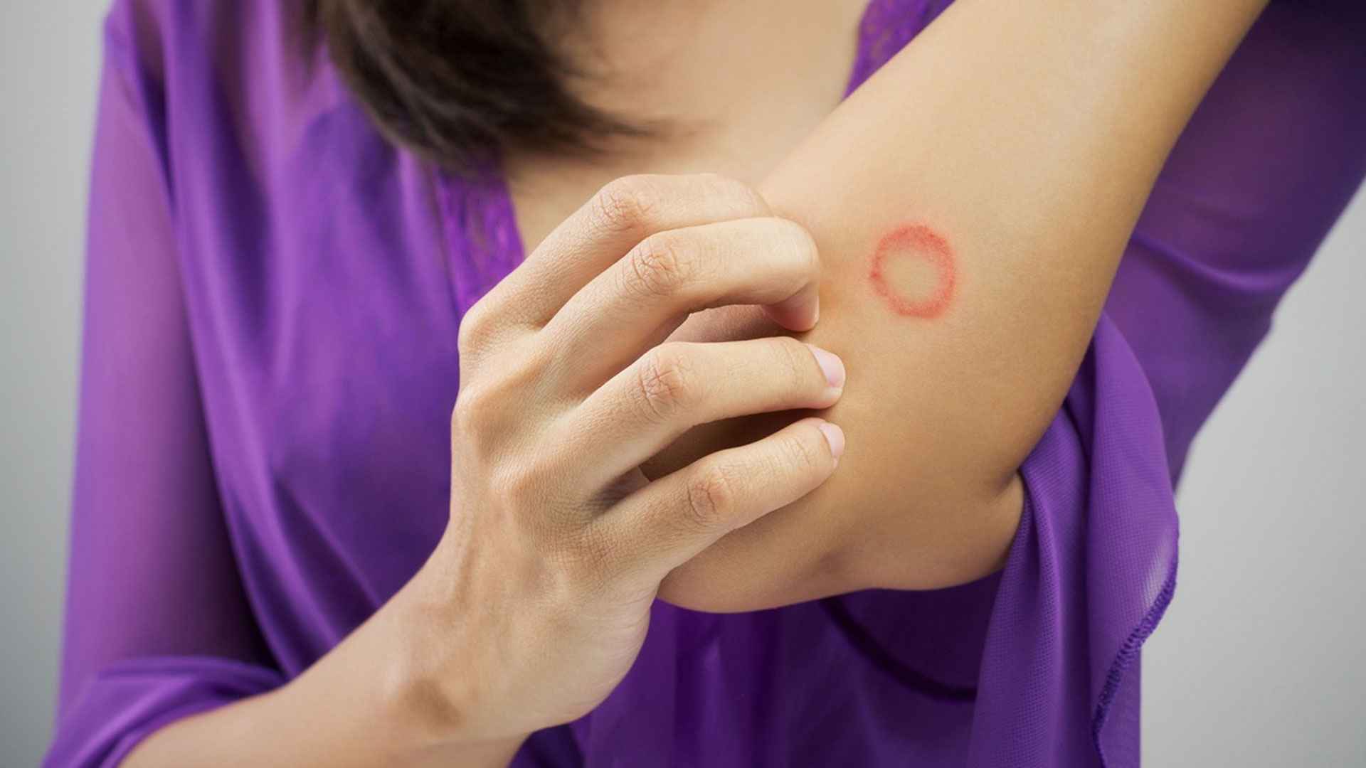 দাদের সংক্রমণ ক্রমশ বাড়ছে, নেপথ্যে কারণ কী?