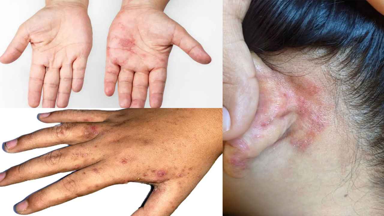 দেশে ছোঁয়াচে ‘স্ক্যাবিস’ রোগের সংক্রমণ বাড়ছে, কারণ ও প্রতিকার কী?