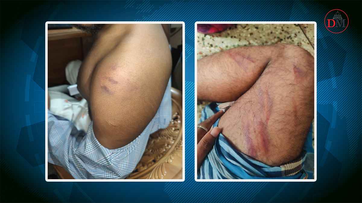 রুমে আটকে রাতভর নির্যাতন, প্লাস দিয়ে টেনে তুলেছে নখ!