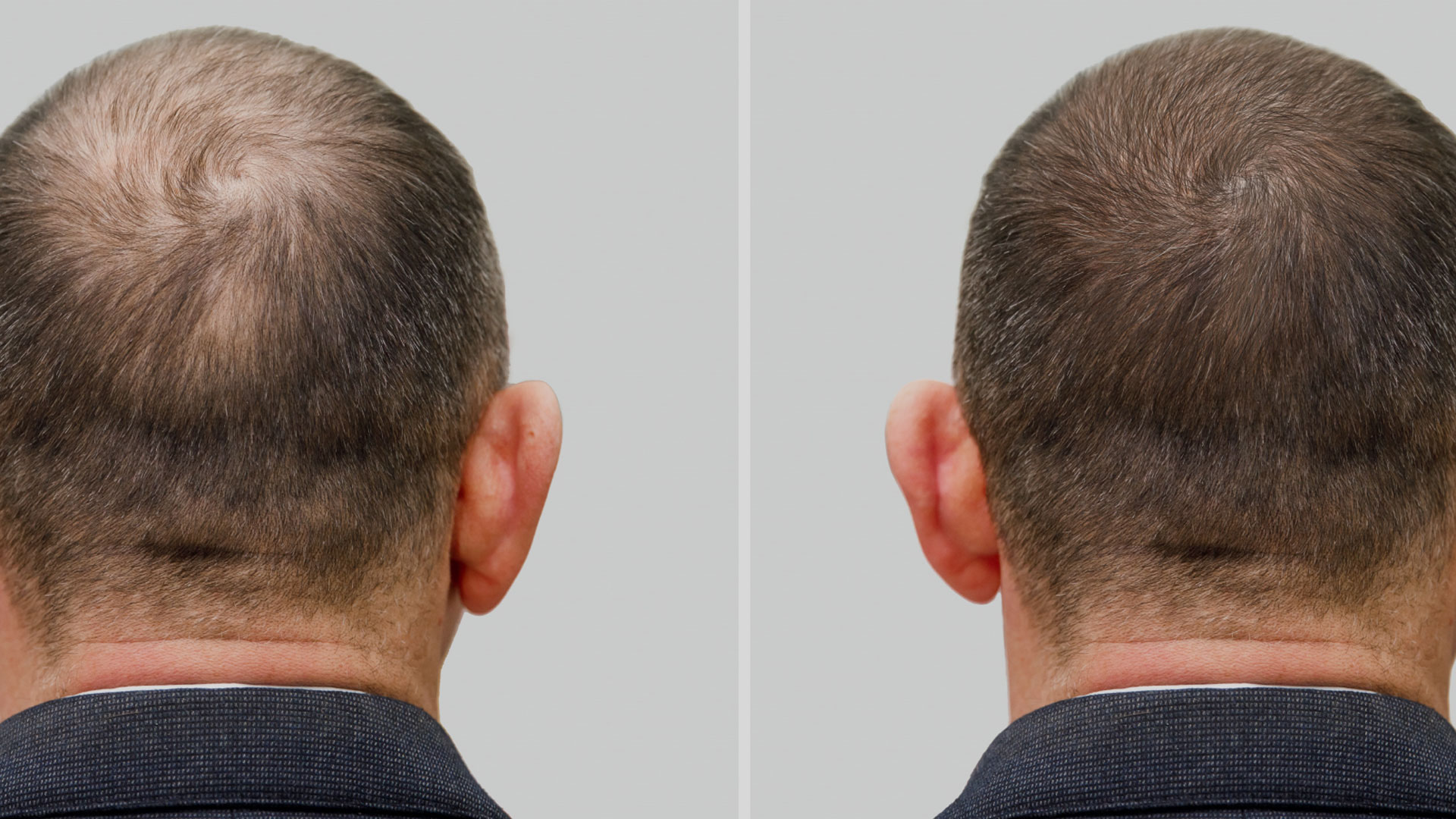 hair-transplate2 hair-transplate2