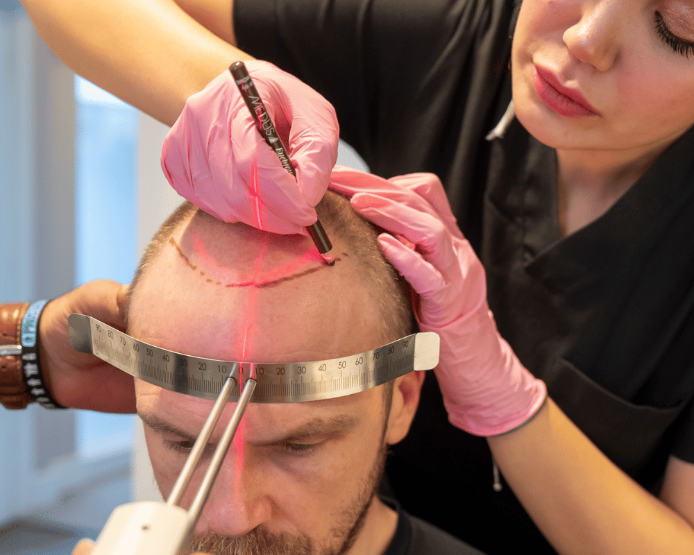 hair_transplate4 hair_transplate4