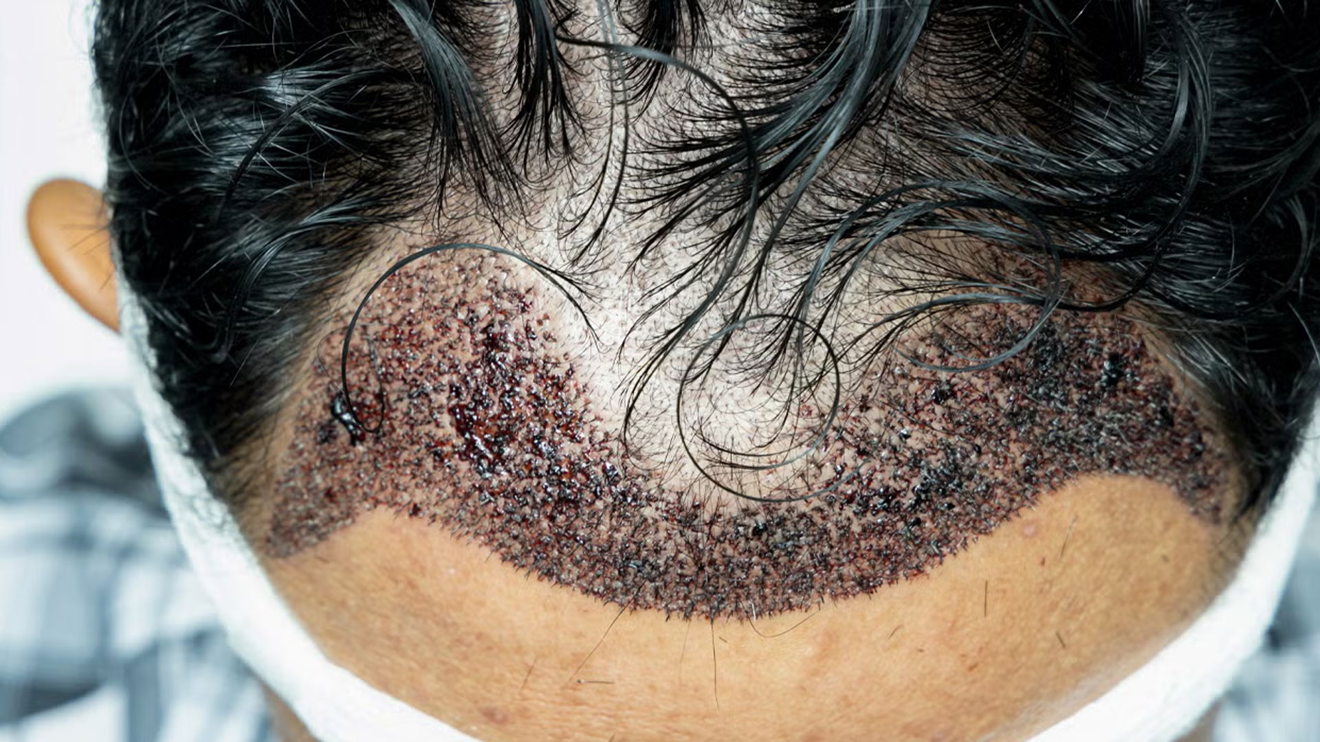 hair_transplate_2 hair_transplate_2