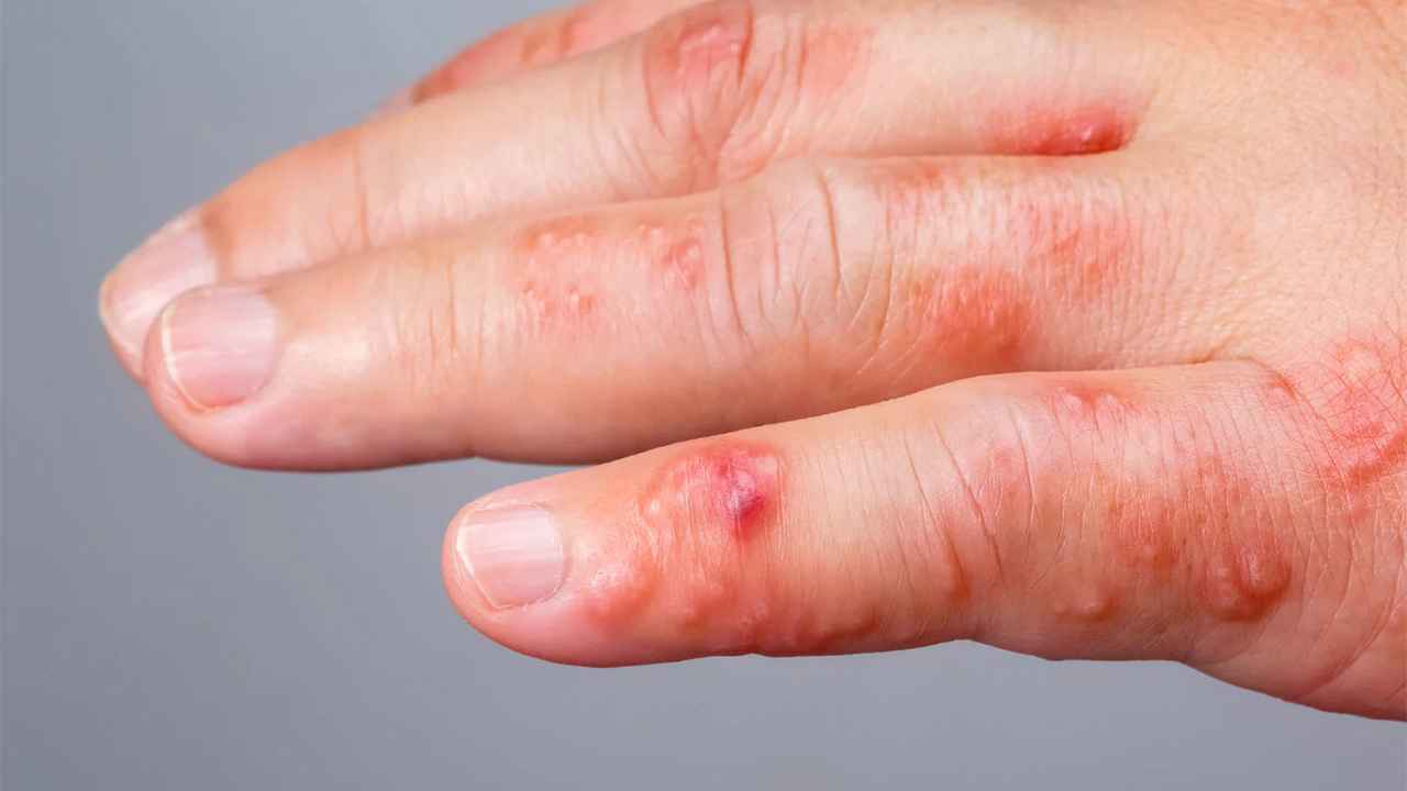 স্ক্যাবিস