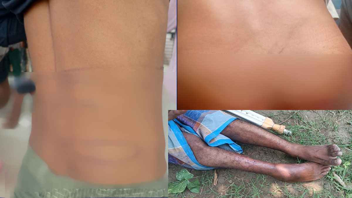 বাংলাদেশে পাঠানো ৭৮ জনের শরীরে নির্মম নির্যাতনের চিহ্ন
