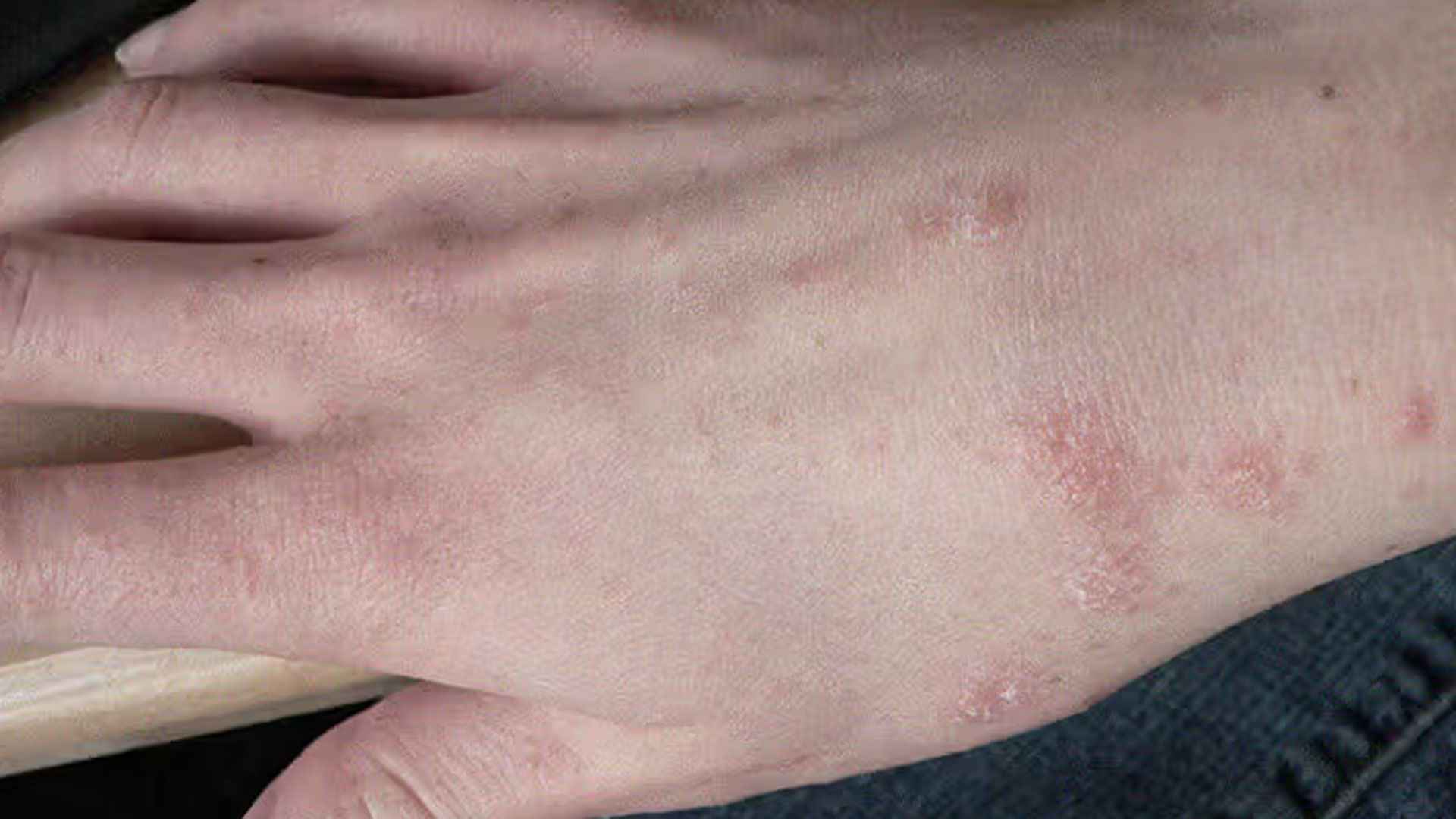 স্ক্যাবিস প্রতিরোধের উপায়