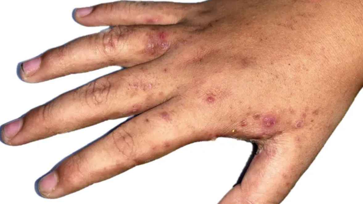 ছোঁয়াচে ‘স্ক্যাবিস’ রোগের সংক্রমণ বাড়ছে কুমিল্লা ও রাজশাহীতে, কারণ কী?