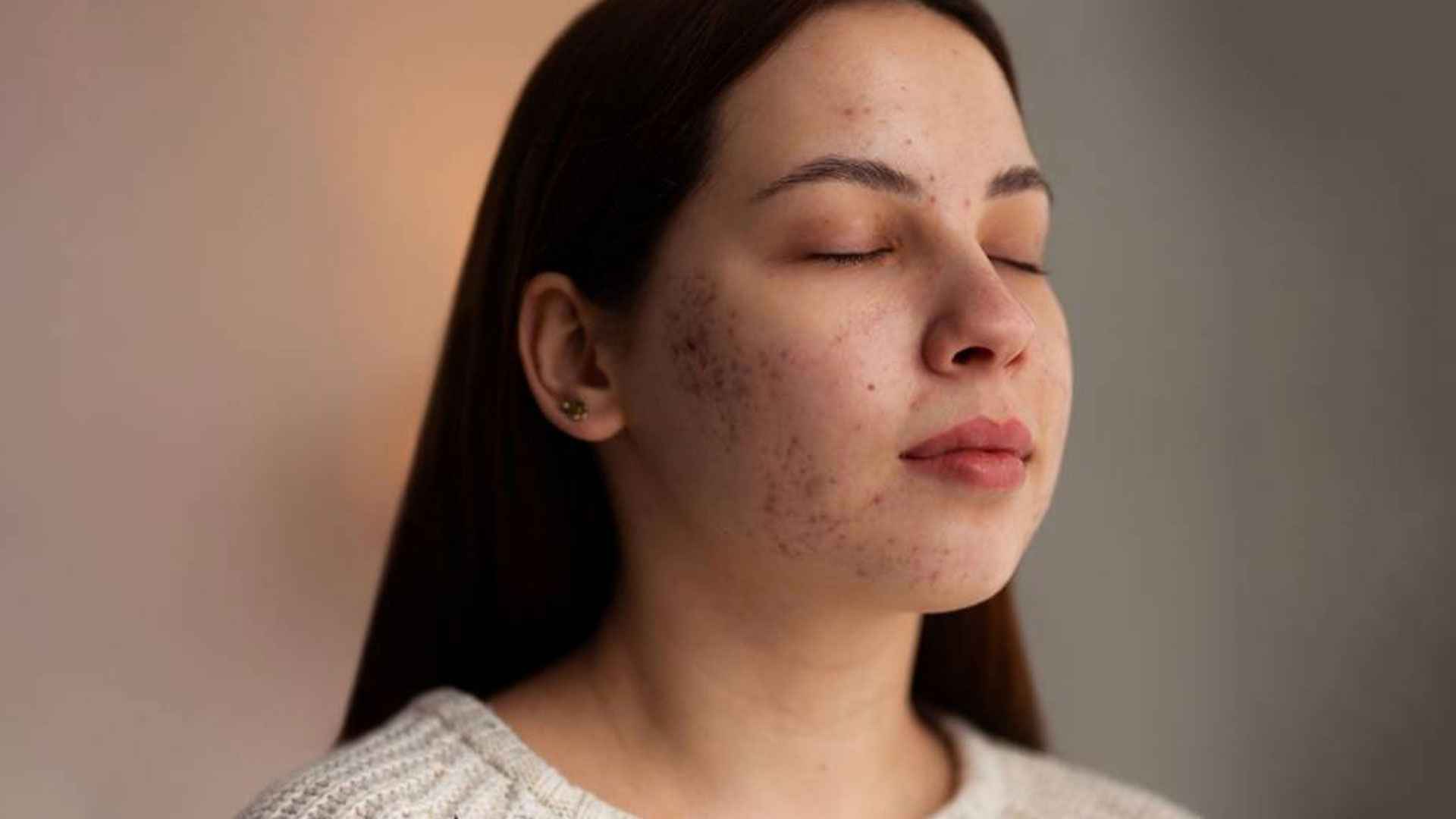 মেছতার দাগ দূর করার ঘরোয়া উপায়