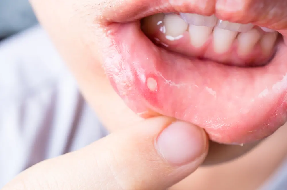 mouth-ulcer_(1)