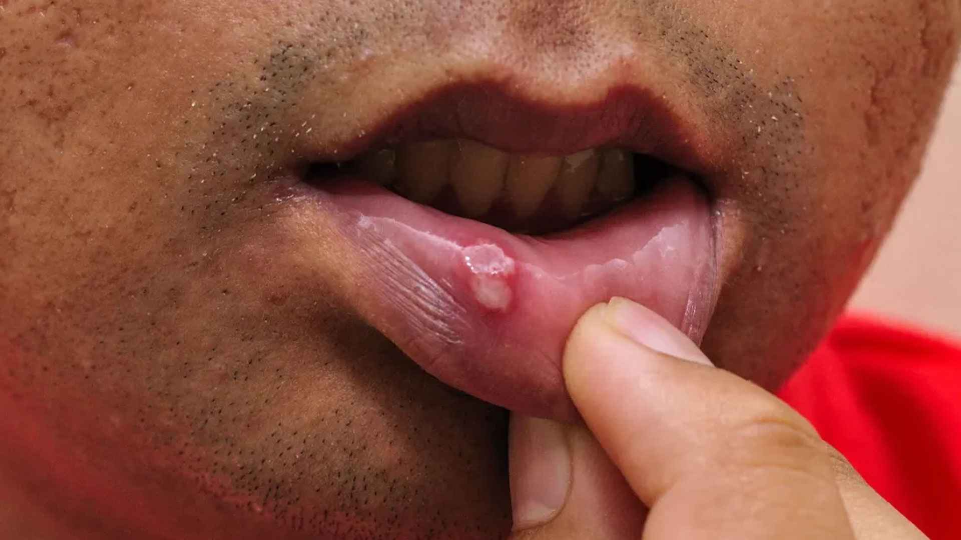 শীতে মুখে আলসার হয় কেন? করণীয় জানুন 