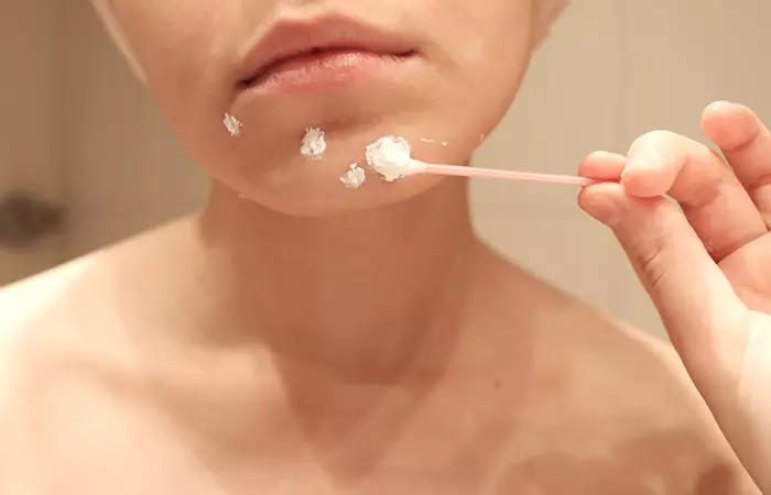 acne acne