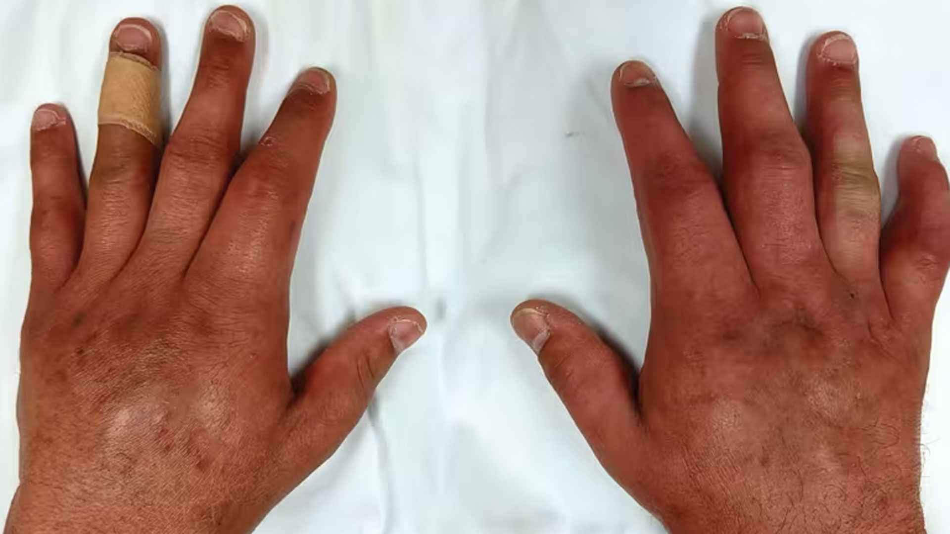 হাতের আঙুল ফুলে গেছে? হতে পারে এসব রোগের ইঙ্গিত