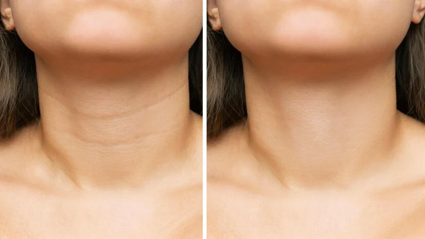 neck_lines1