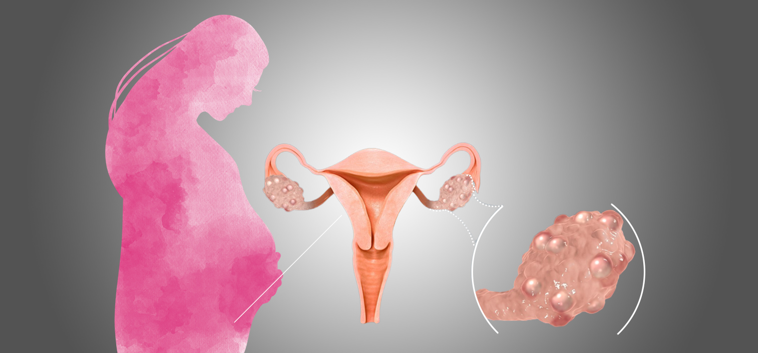 pcos1 pcos1