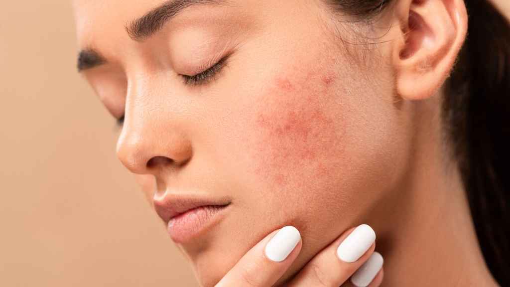 ৩ দিনে ব্রণের দাগ দূর করার ঘরোয়া উপায়