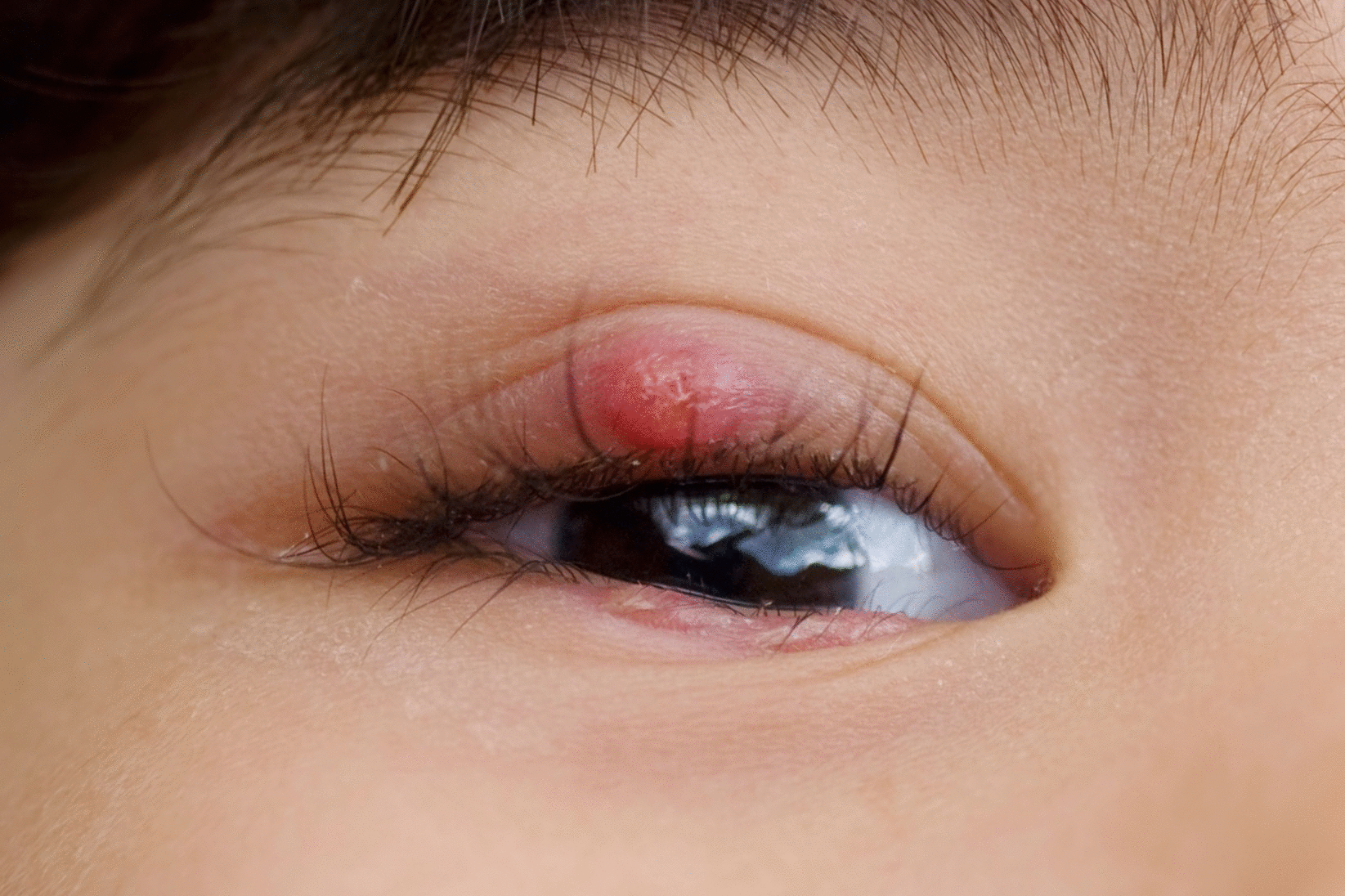 স্টাই বা আঞ্জনি