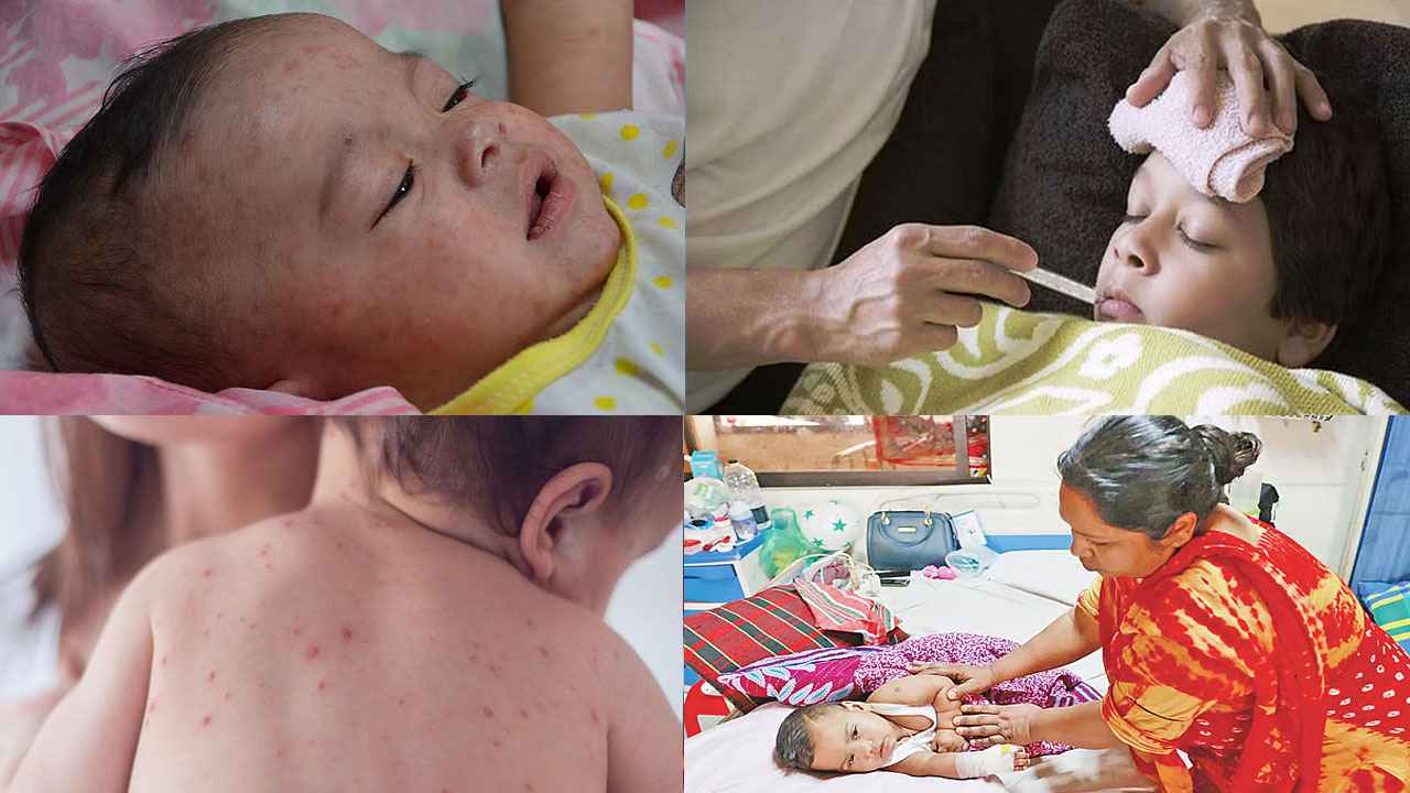 হাম কীভাবে ছড়ায়, প্রতিকার কী