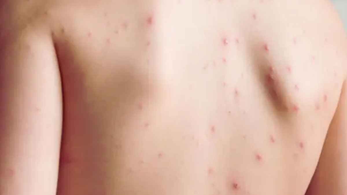 যশোরে চিকেন পক্সে একজনের মৃত্যু