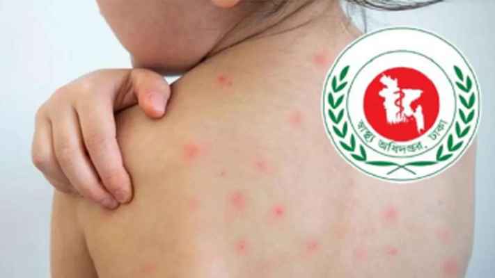 বরিশালে হামের উপসর্গ নিয়ে শিশুর মৃত্যু