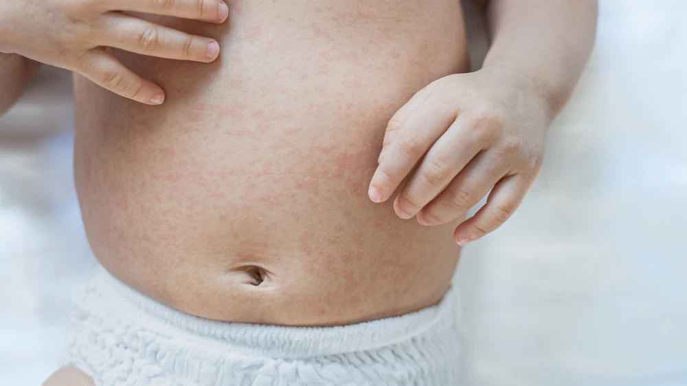 যেসব শিশুকে হামের টিকা দেওয়া যাবে না