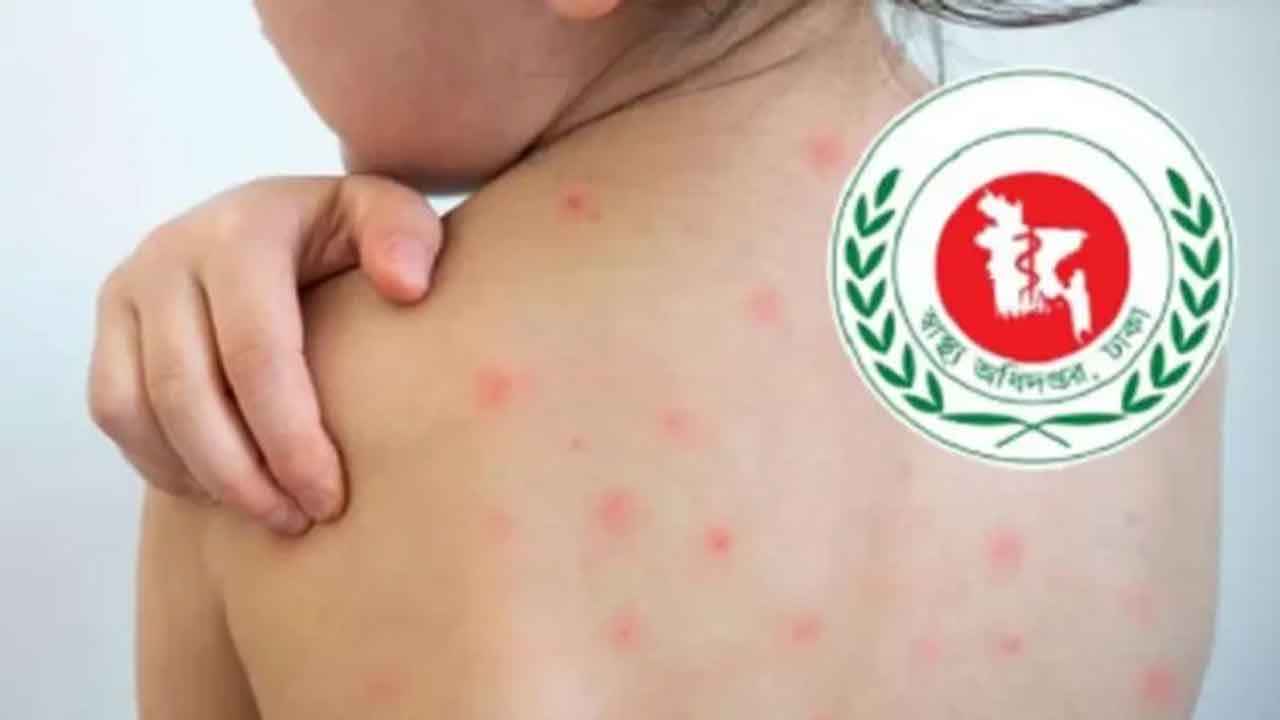 হাম ও উপসর্গে আরো ৩ শিশুর মৃত্যু, আক্রান্ত ১১৭০