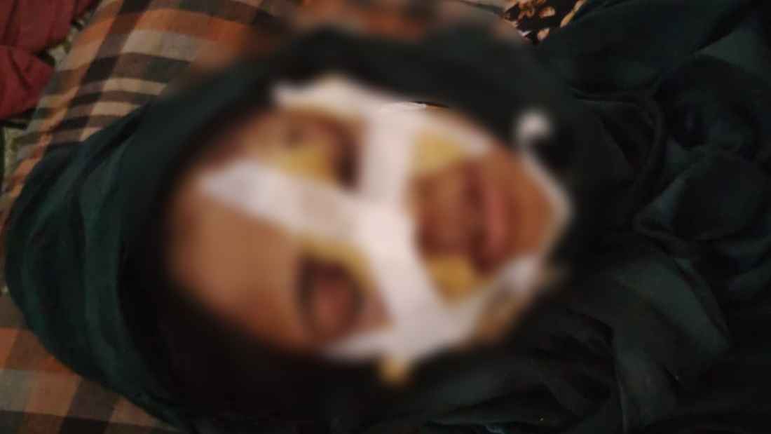 নড়াইলে সাবেক স্বামীর হামলায় গৃহবধূ জখম, শরীরে ৪৫ সেলাই