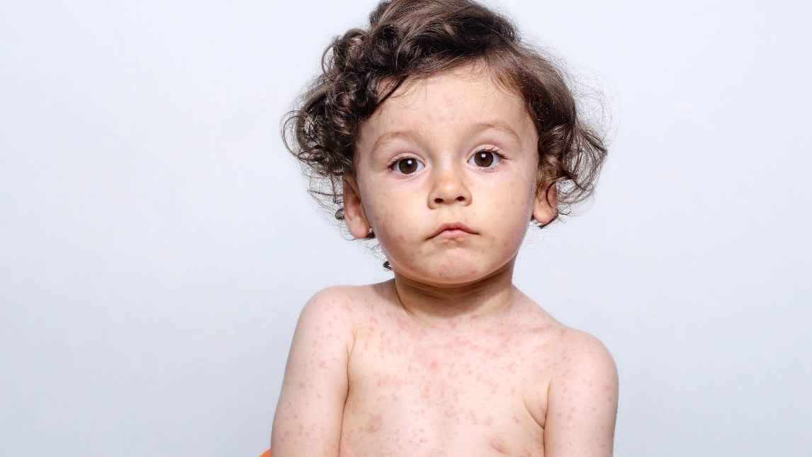 হাম সম্পর্কে যে তথ্যগুলো জানা উচিত সবার 